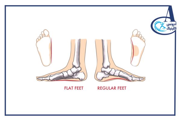 صافی کف پا چیست - ادونس کلینیک